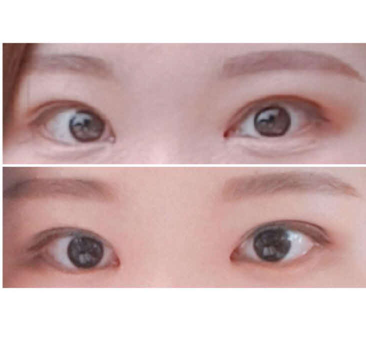 매몰+윗트