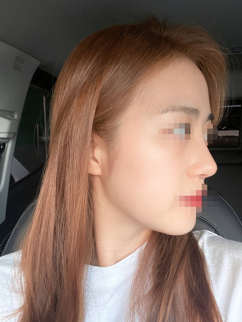 붓기빠지는건 두달 봐야한다는데 지금도 너무 예쁨 ᅲᅲ