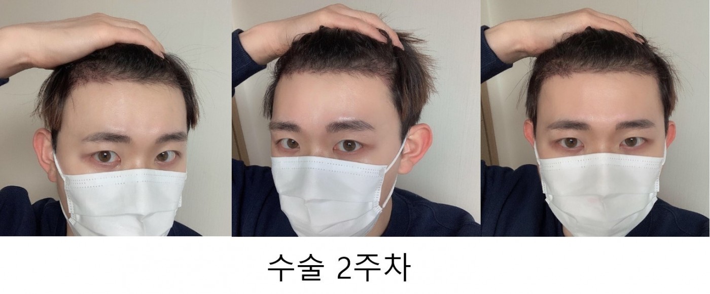 모발이식 2주차 후기 올립니다~~