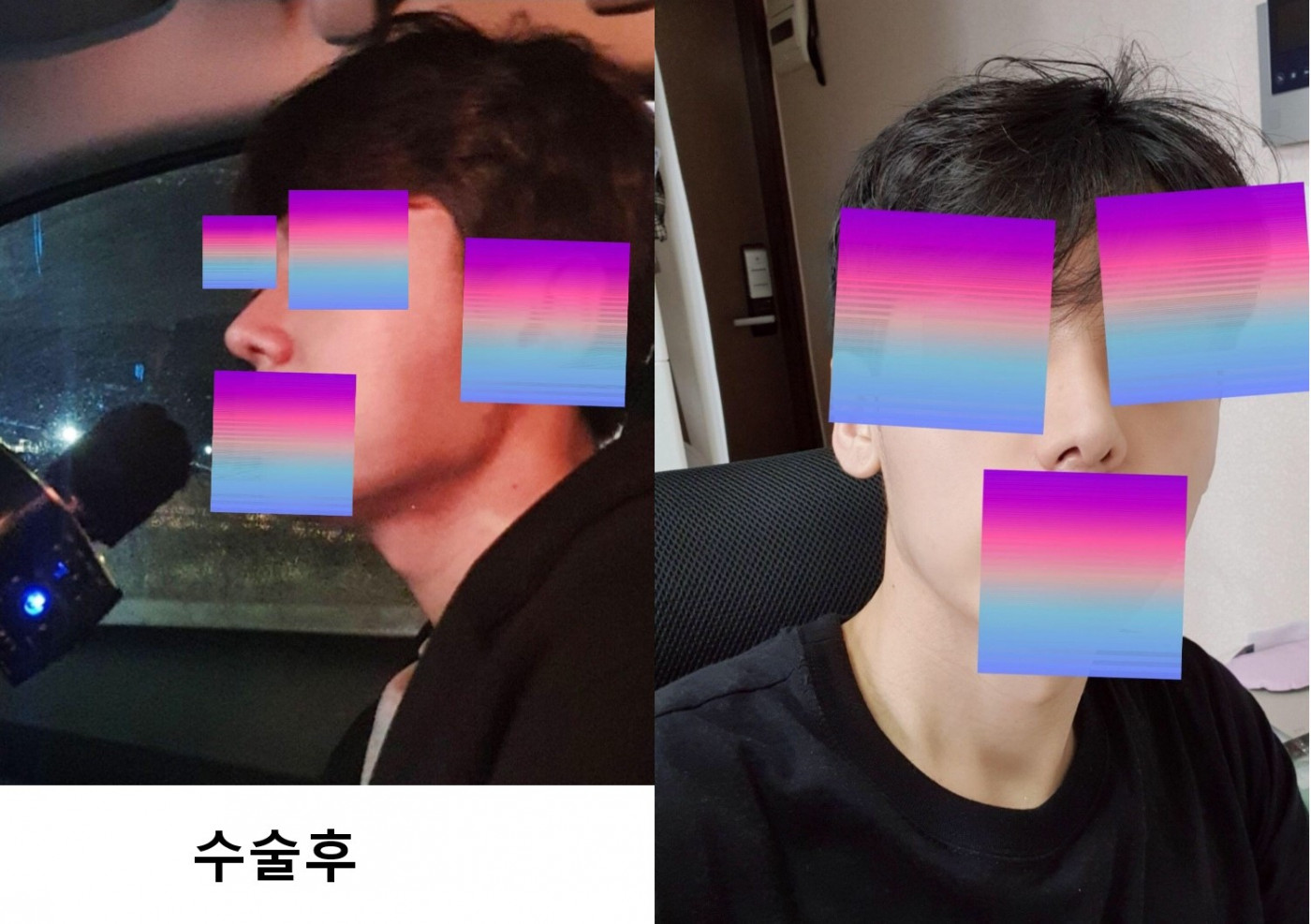 남자 코 수술 후기예요
