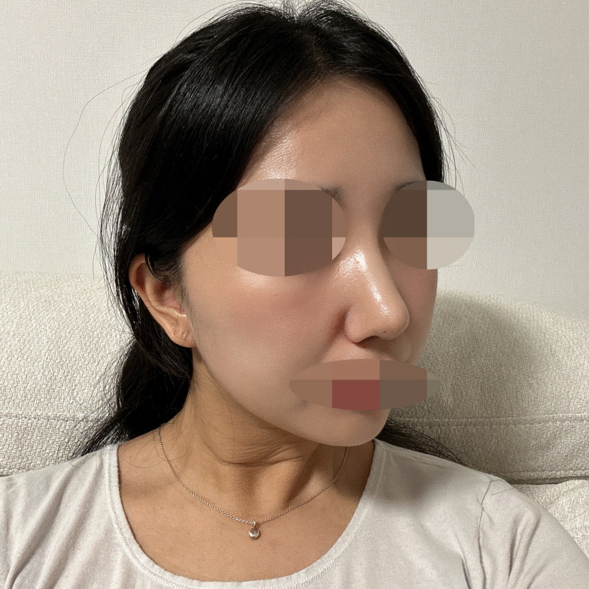 휜 부분도 잘 교정되었고 자연스럽게 잘 해주셨어요!