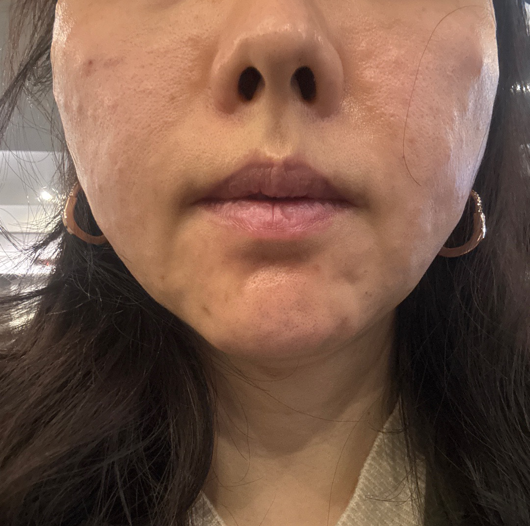 오랜만에 리프팅 받았는데 수면으로 편하게 했어요~
