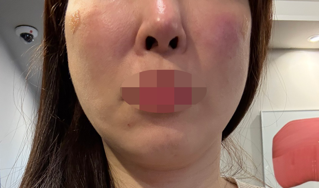 빠른 응대와 친절한 상담으로 기분 좋게 리쥬란 받았어요ㅎㅎ~
