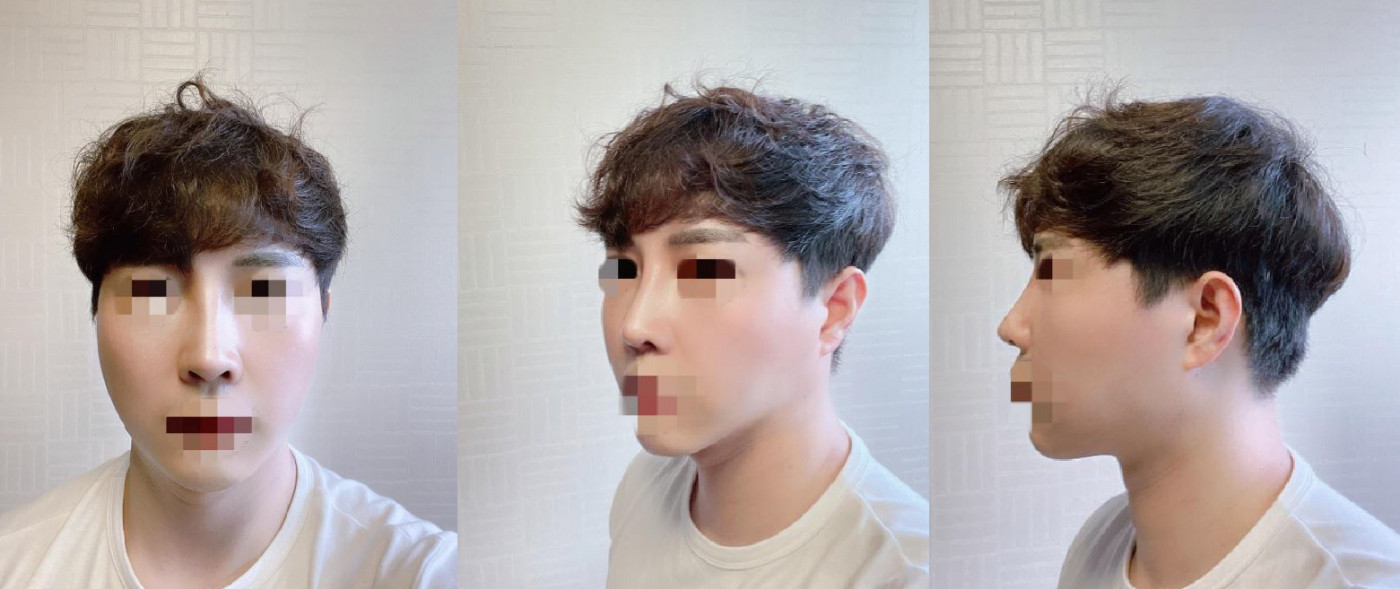 코수술입니다
