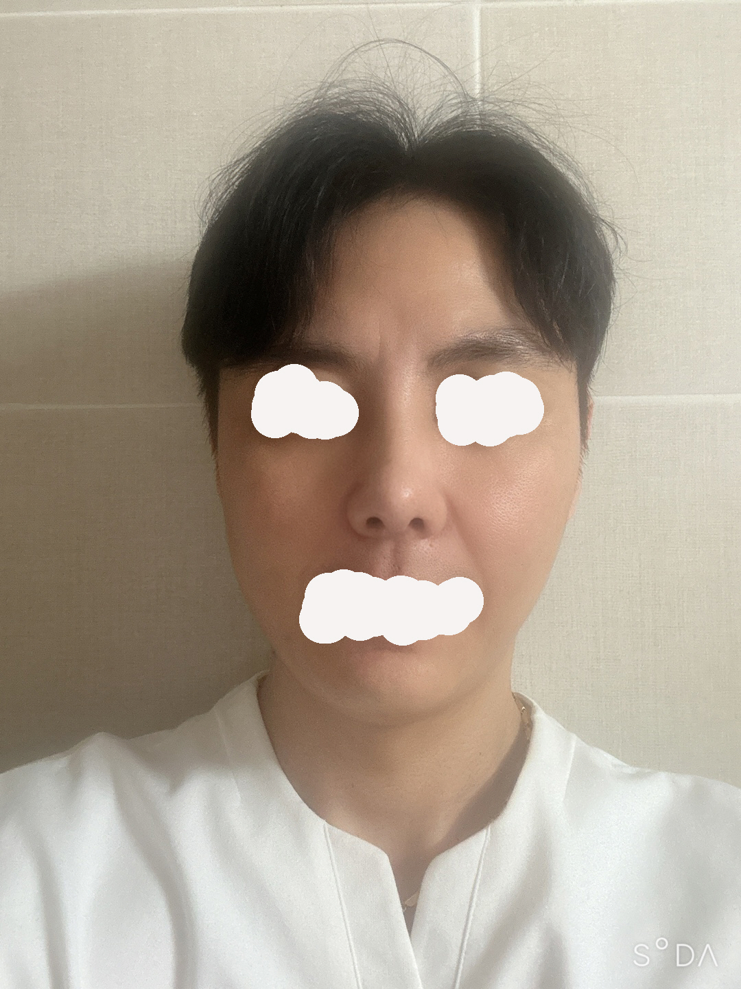 황정일 원장님 추천드립니다 다들 성공스러운 코수술 되세요 ᄒᄒ