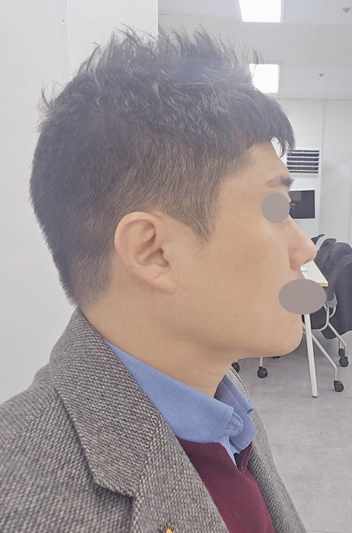 남자 코재수술 4달차, 자연스럽게 자리 잡았습니다.