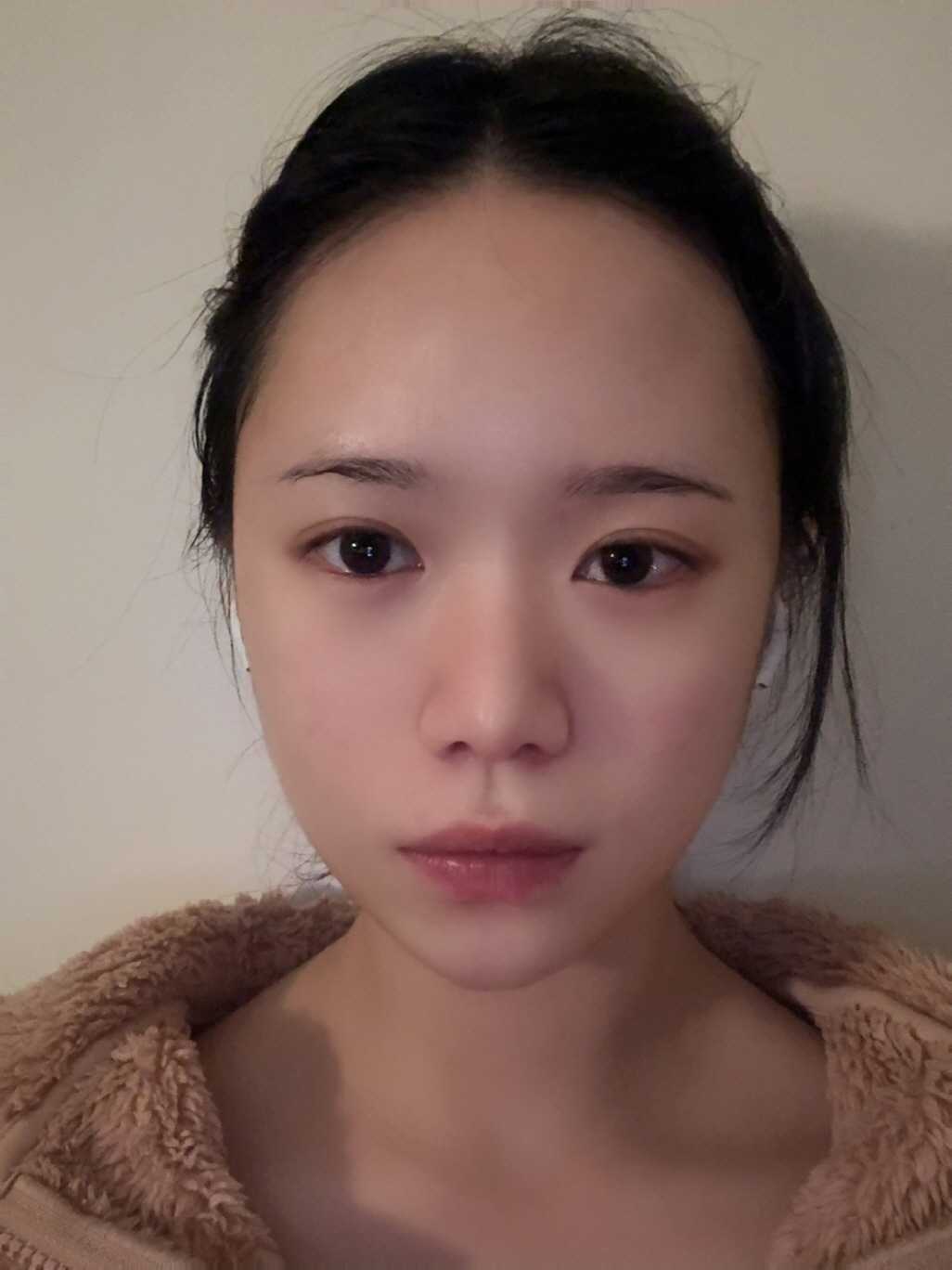 붓기 빠지면서 더 자연스러워지고 있어요! 이젠 통증도 없어용
