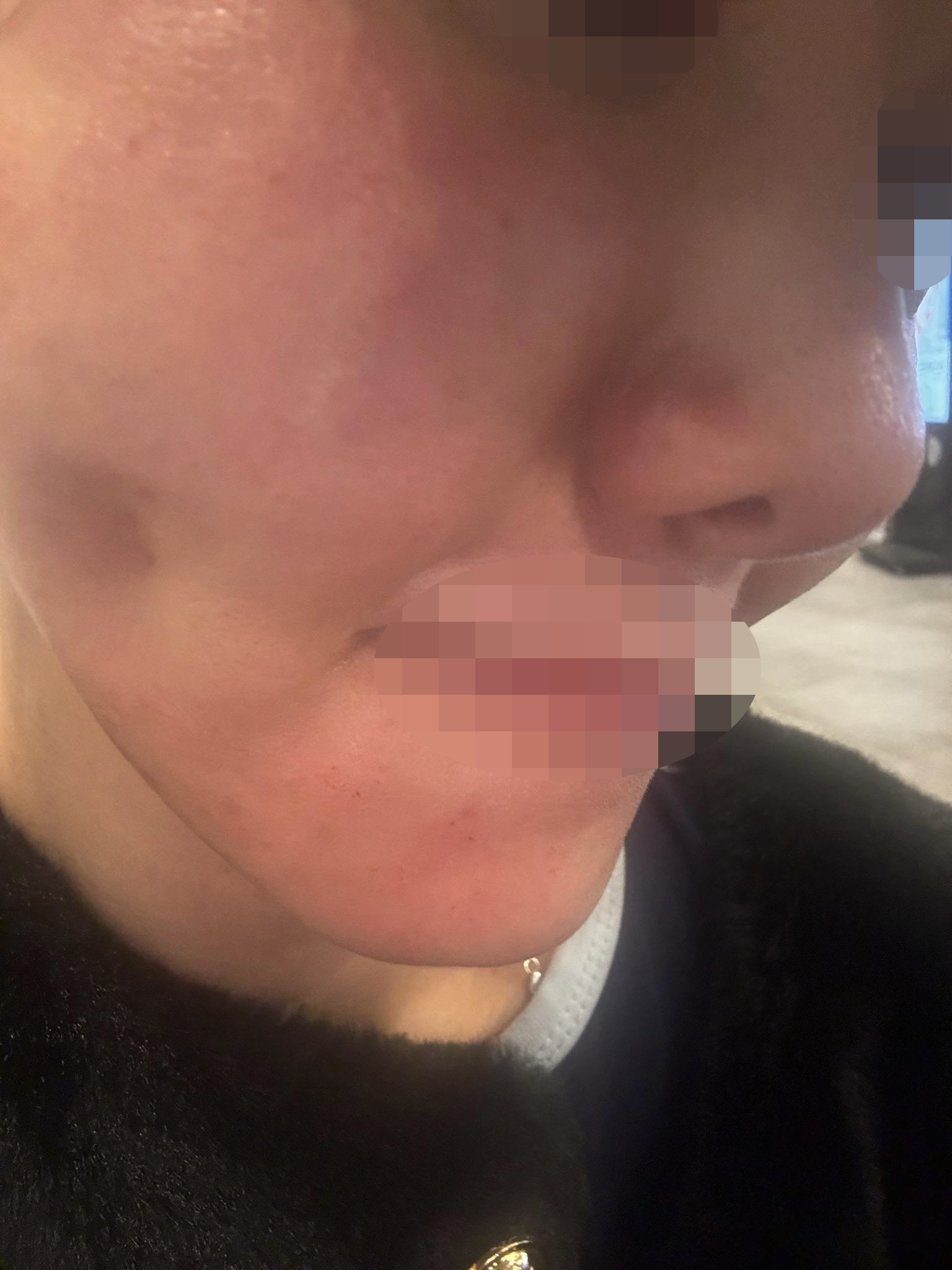 갑자기 생긴 여드름 자국, 엑소좀으로 관리하니 확연히 달라졌어요~