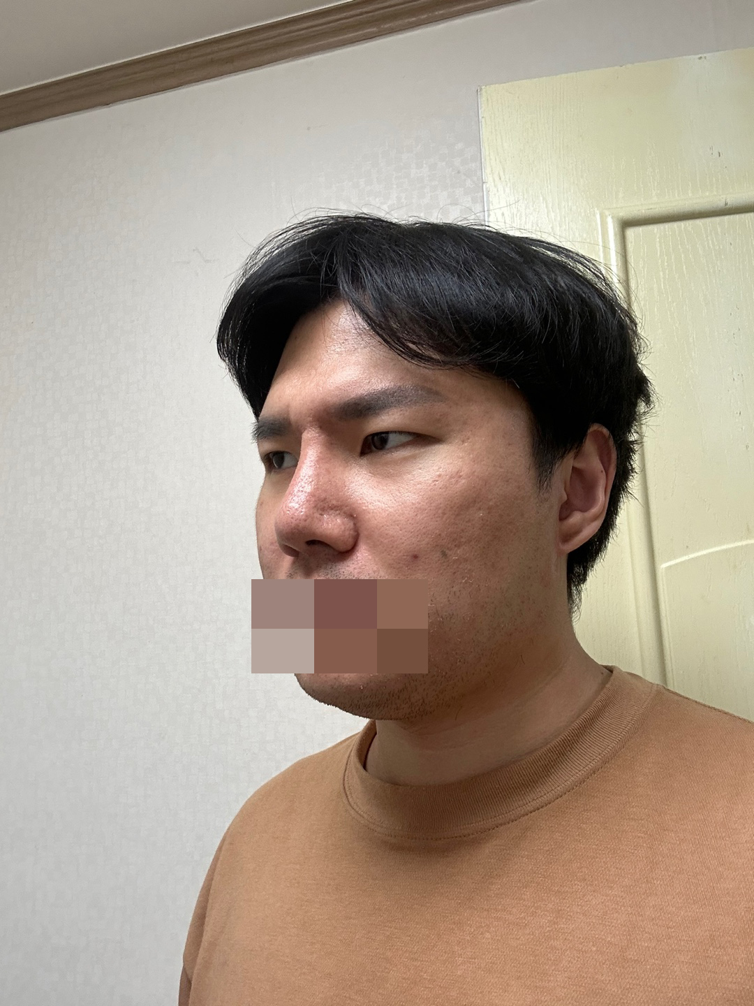 코 성형과 무쌍눈매교정+앞트임 매우 만족합니다