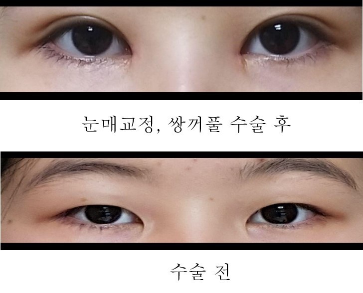 황원장님께 눈수술했어요