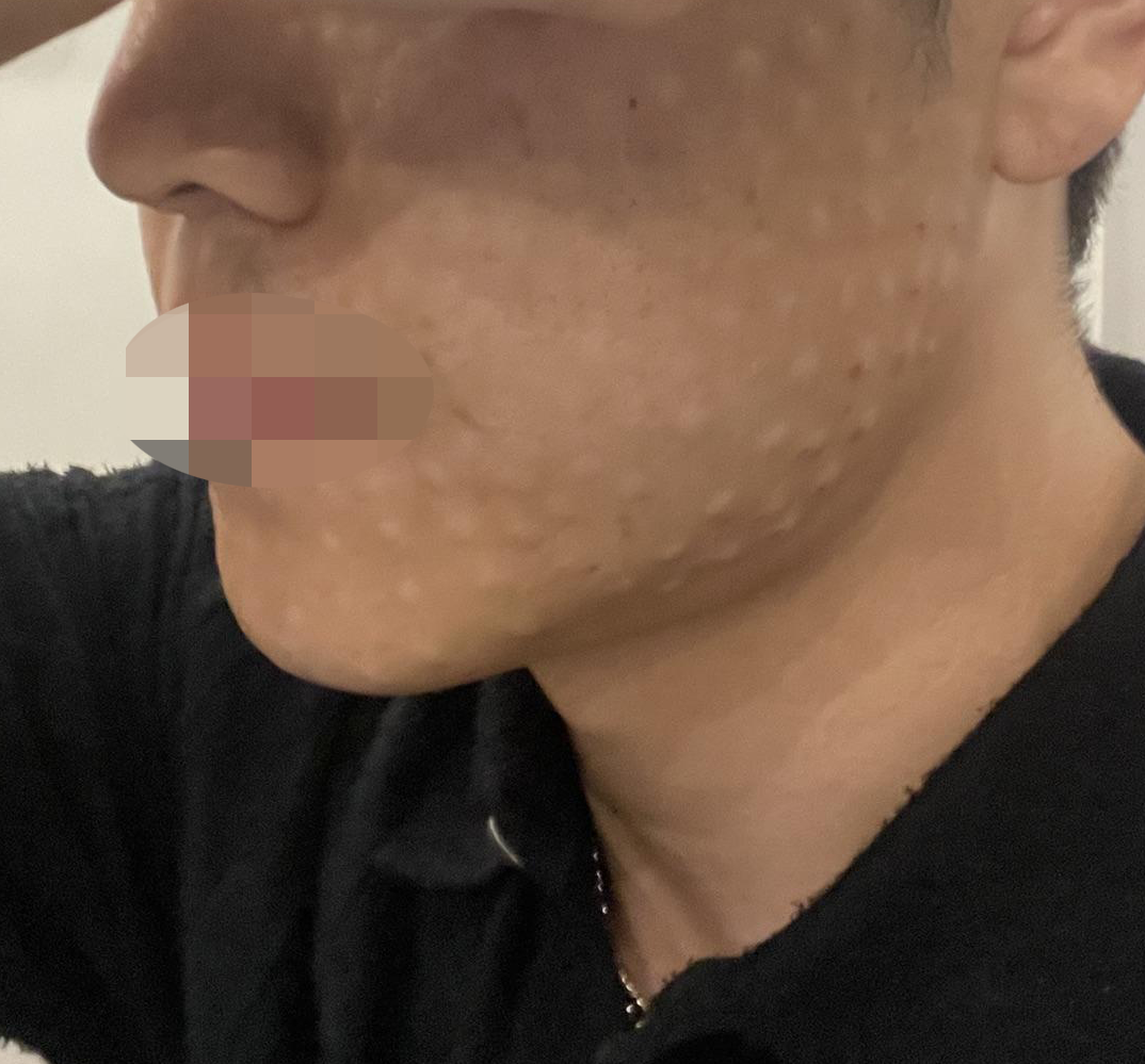 리쥬란 4cc+아이리쥬란 1cc 함께 받아봤어요~!