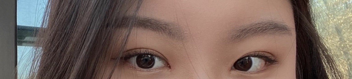 부분절개 + 앞트임 + 눈매교정 한달차임당