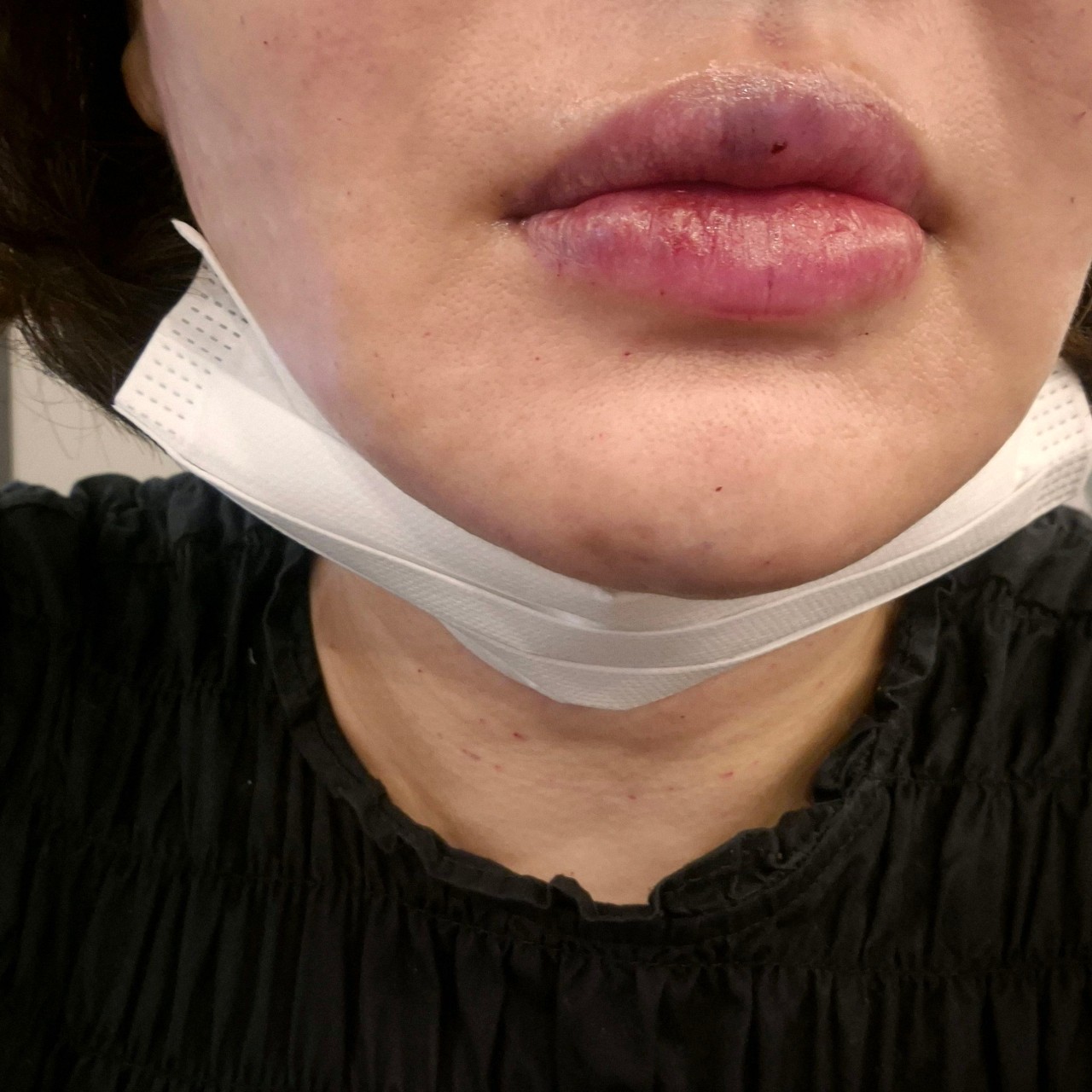 시술 직후라 부기는 있지만 입술 라인이 또렷해진 게 보여요~