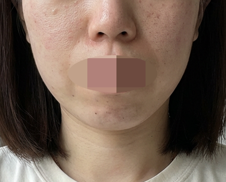 여름에도 속건조는 여전해서 리쥬란 받으러 방문했어요~