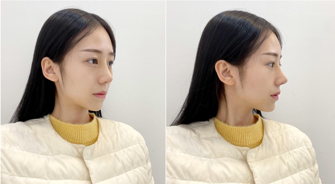 코수술