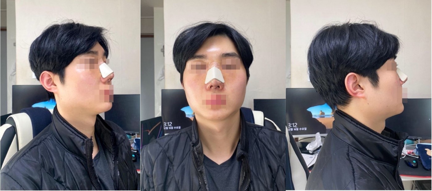 매부리코