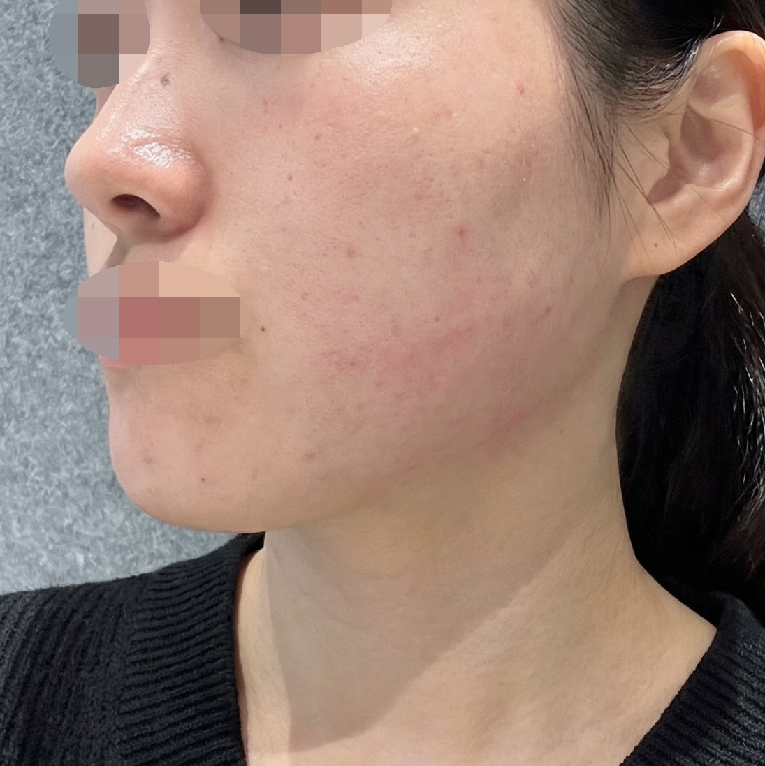 자고 일어나니 슈링크 끝나 있어서 너무 만족이에요!!