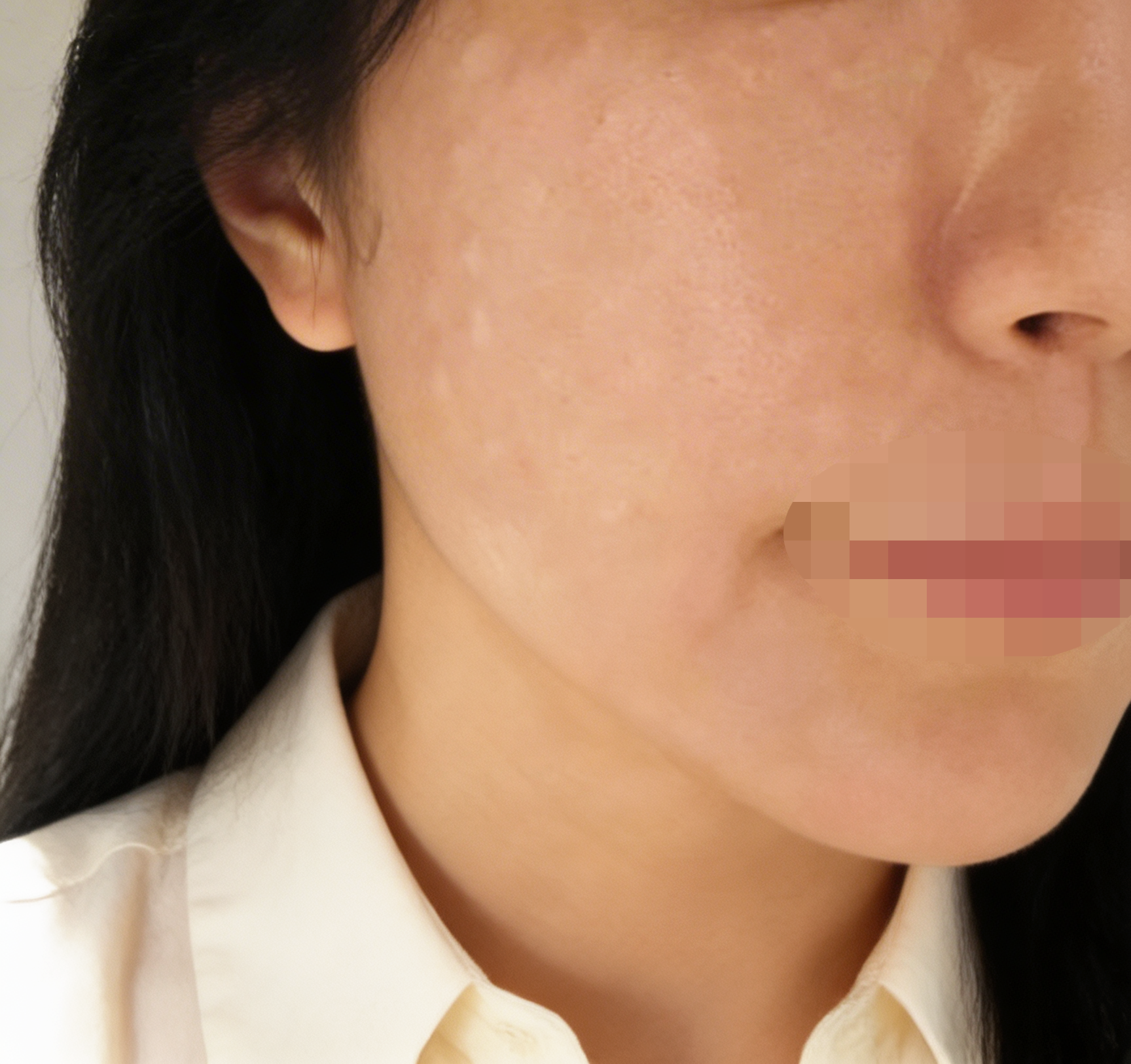 꾸준히 스킨부스터 받는 편인데 계절 상관없이 리쥬란이 필수인 것 같아요