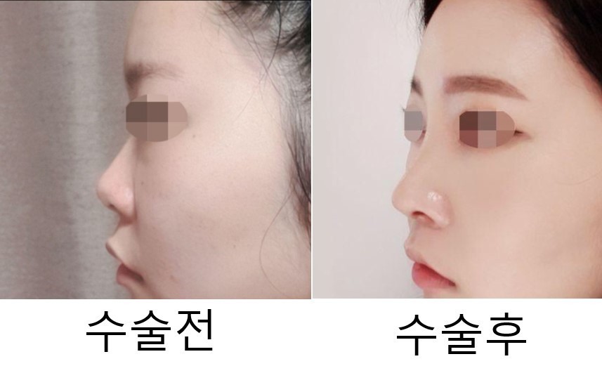 들창코수술후기