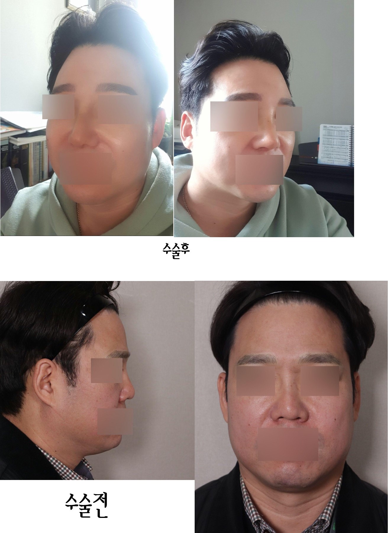 코수술