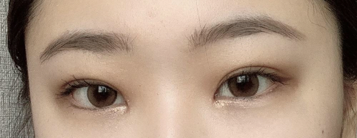 눈 수술후기 ㅋㅋ