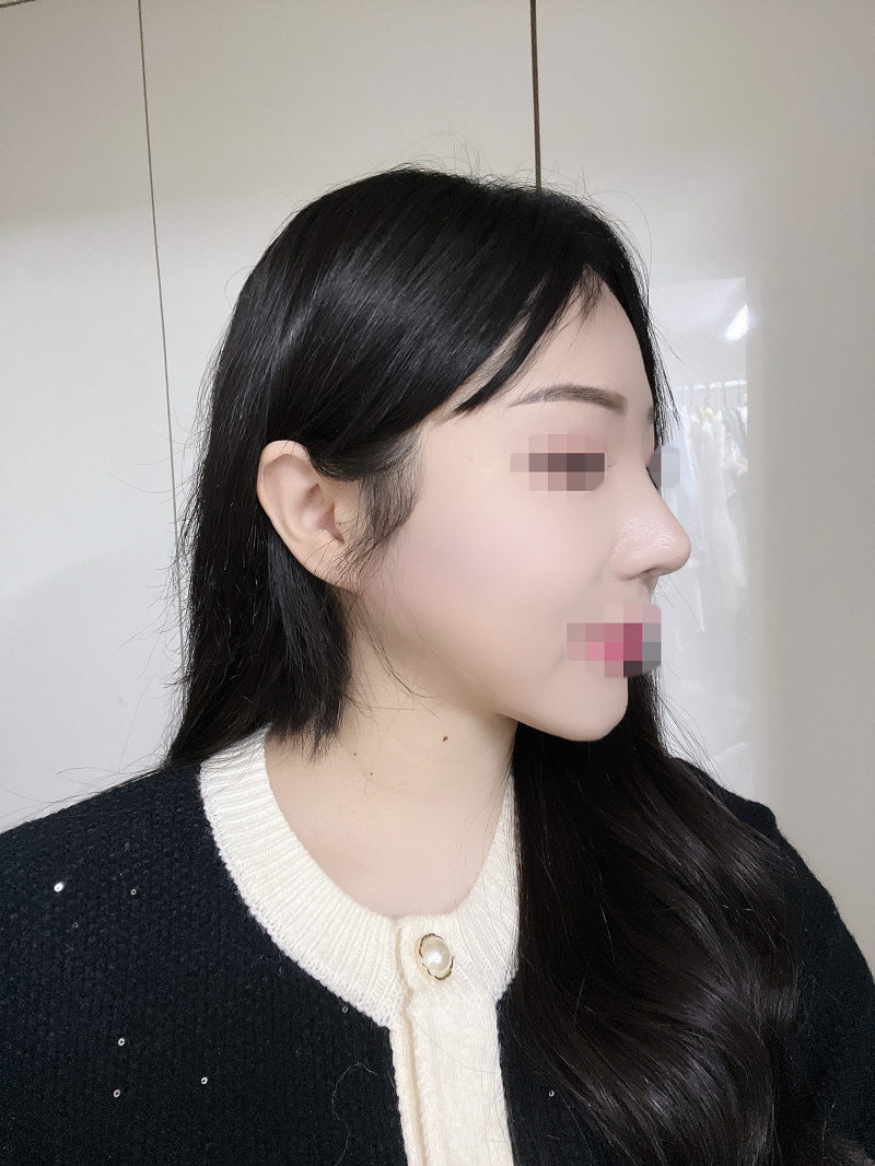 예전얼굴이 너무그리웠는데 원장님이 다시 중안부는 짧고 코끝은 높게 고쳐주셨습니다 진짜 마지막 수술이에요 인생에서 ᄒᄒ