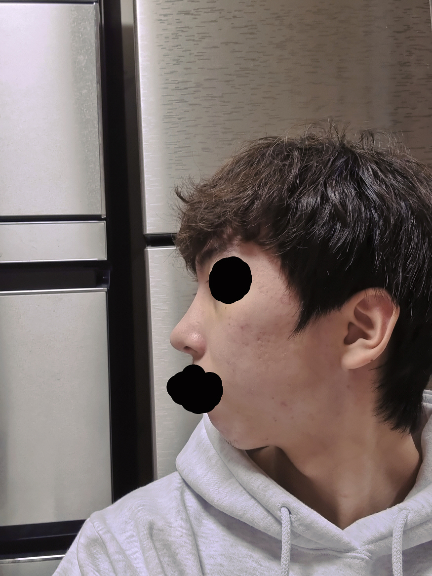 붓기는 금방 빠지고 생각보다 하나도 아프지 앉았어요!!