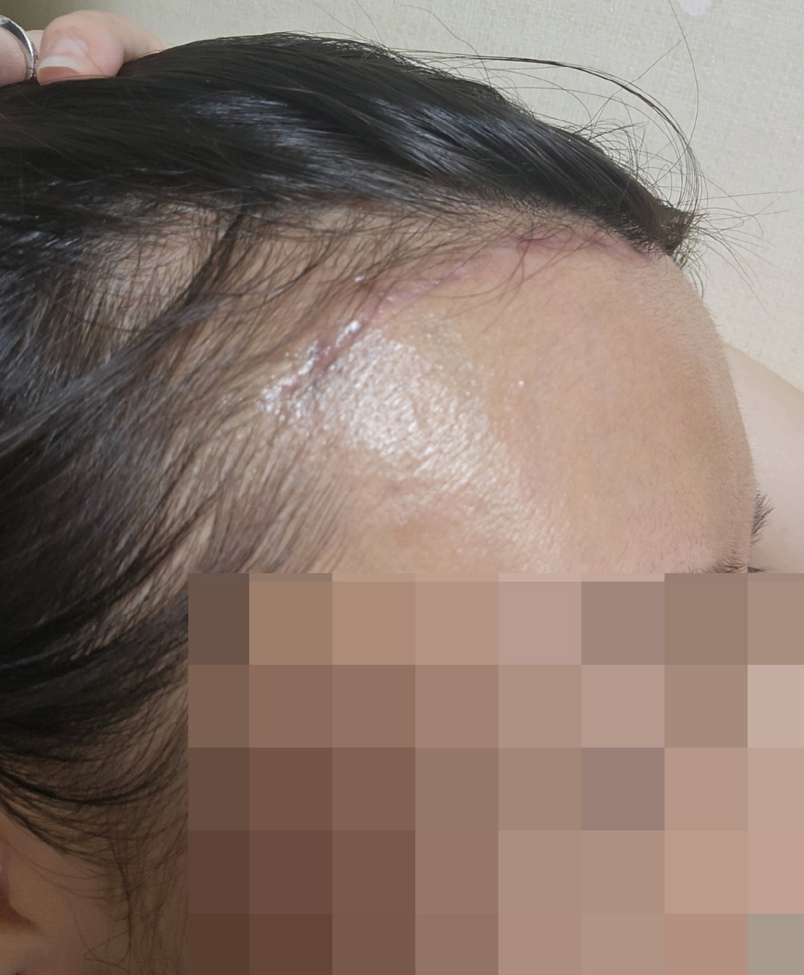 이마 라인이 눈에 띄게 내려와 얼굴 비율이 훨씬 좋아졌고, 자신감이 많이 생겼습니다.