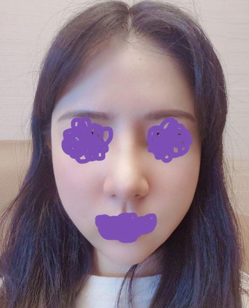 복코 수술했습니다!