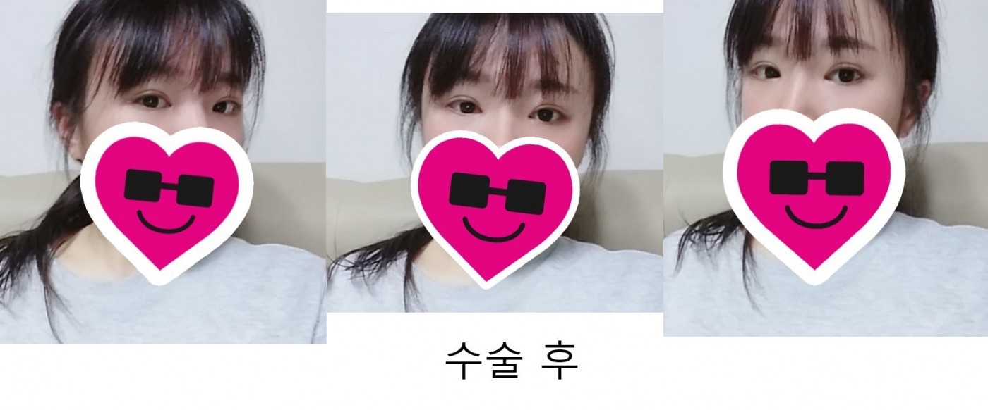 눈재수술~!
