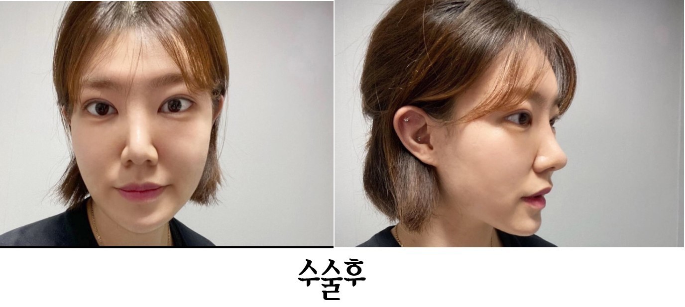 코수술 경과 올려요~!