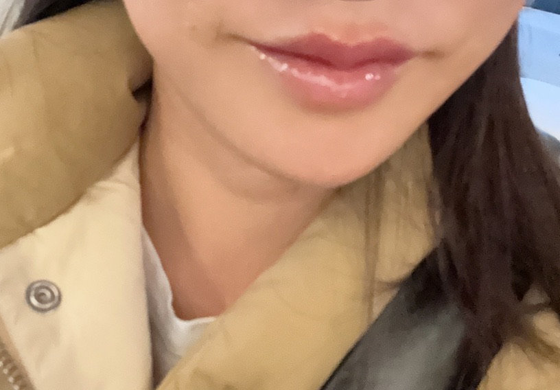 빠른 진행에 꼼꼼한 입술 필러, 다음에도 또 올 것 같아요~