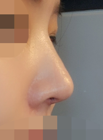 코가 예뻐졌어요