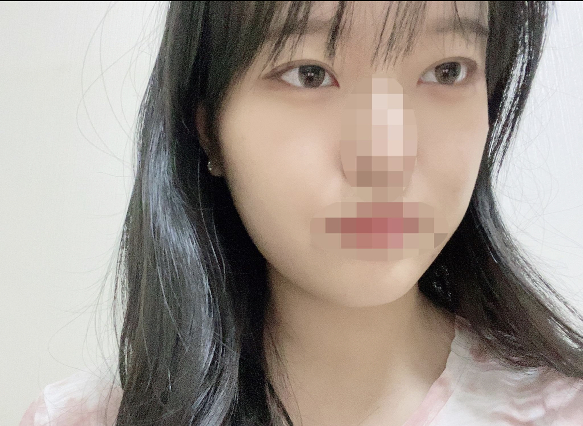 [쌍꺼풀 재수술] 발품 팔아 한 7군데 돌아다닌 것 같은데 여기 진짜 강추입니다..♥