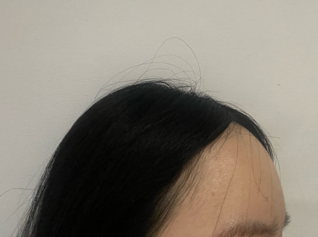 흉터도 거의 사라지고 개선도 잘됐어요 좋습니다