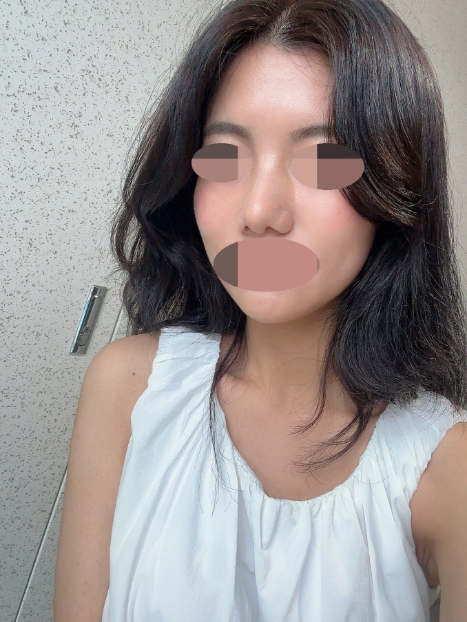 매부리도 잘 교정되고 자연스럽게 자리 잡아가고 있는거 같아요!