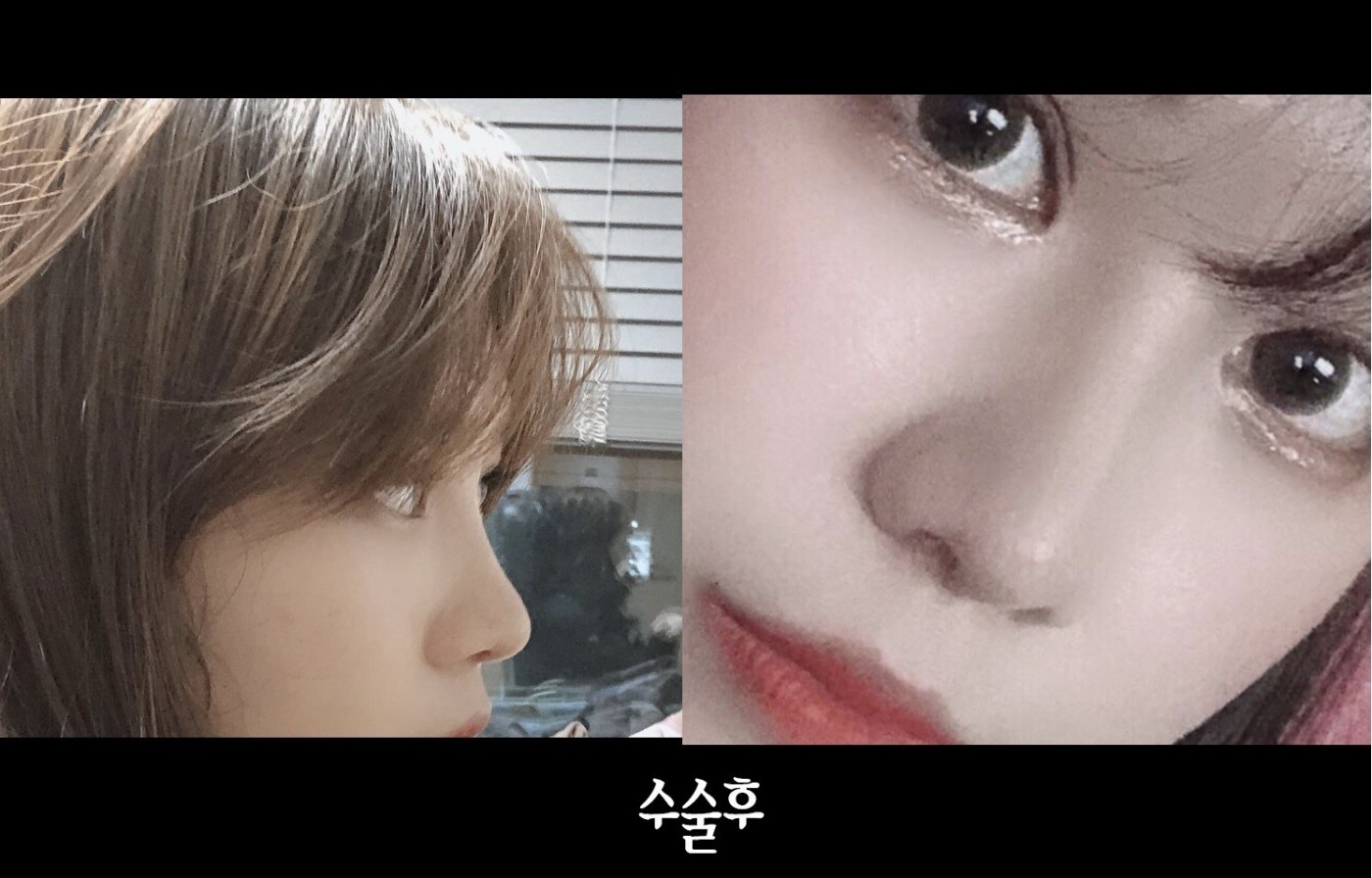 코수술후기올립니당