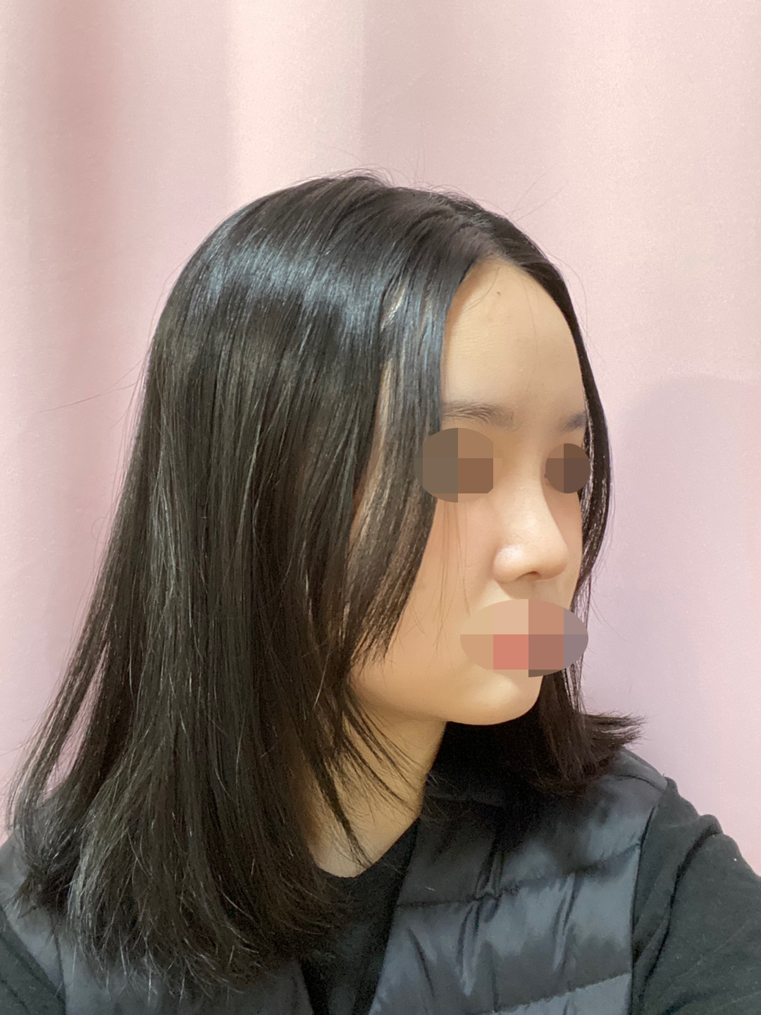 수술하고 난 이후에도 아픈 것도 하나도 없어서 정말 만족합니다!!