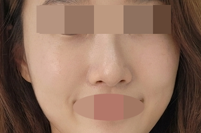 또렷한 인상 되찾으려고 아이써마 수면으로 받아봤어요!
