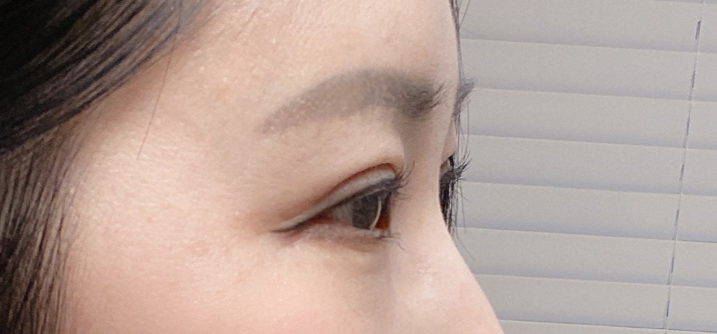 눈재수술 2개월 후기, 세련된 라인으로 개선된 느낌