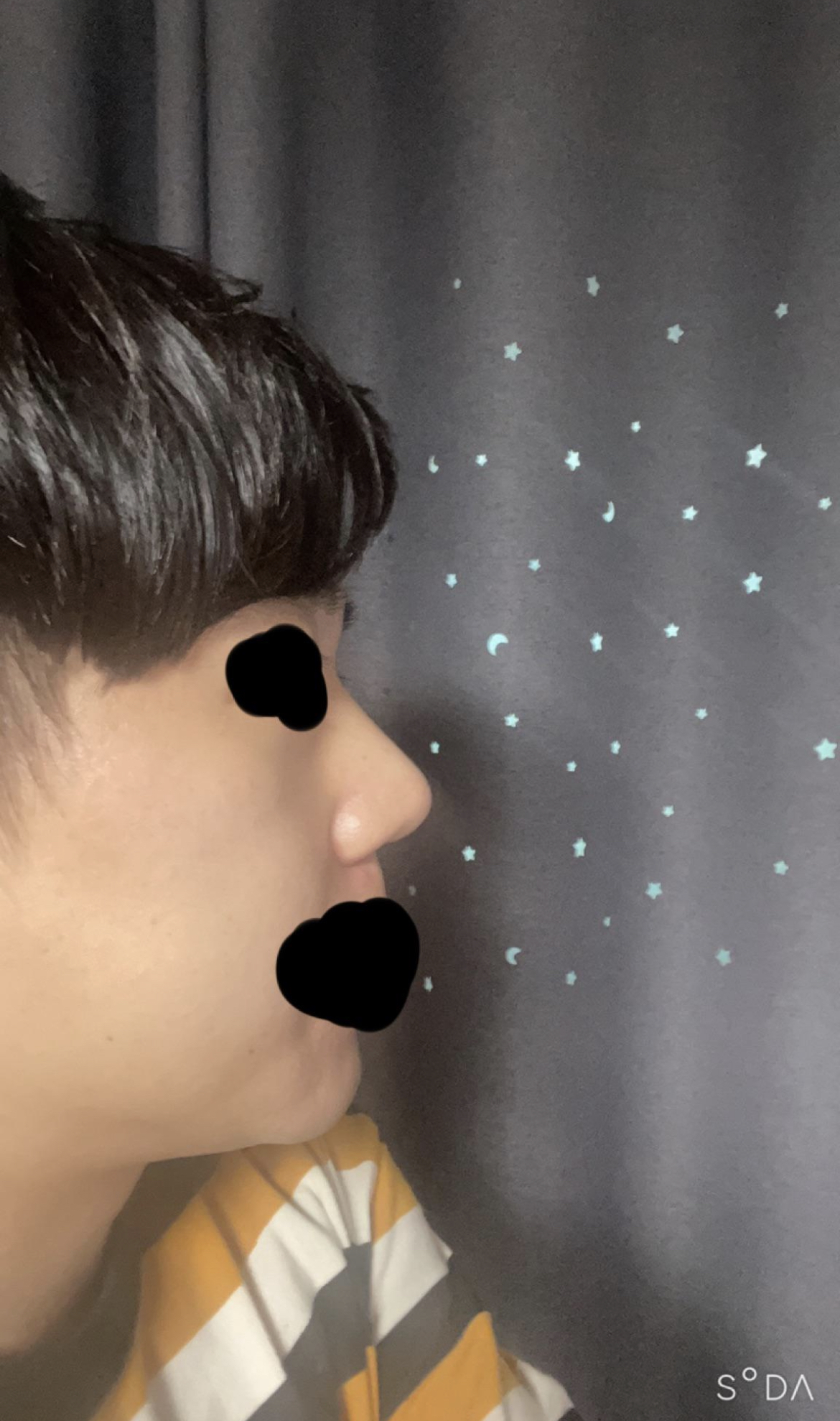 평소에 코가 큰편이라 고민이 많아서 수술했어요