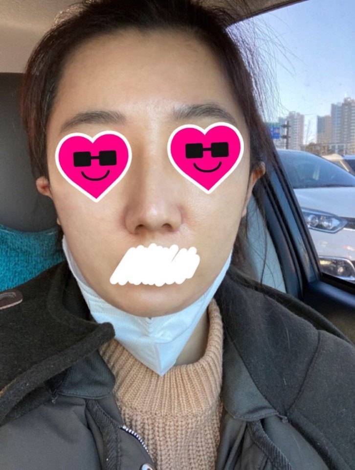 코수술 후기