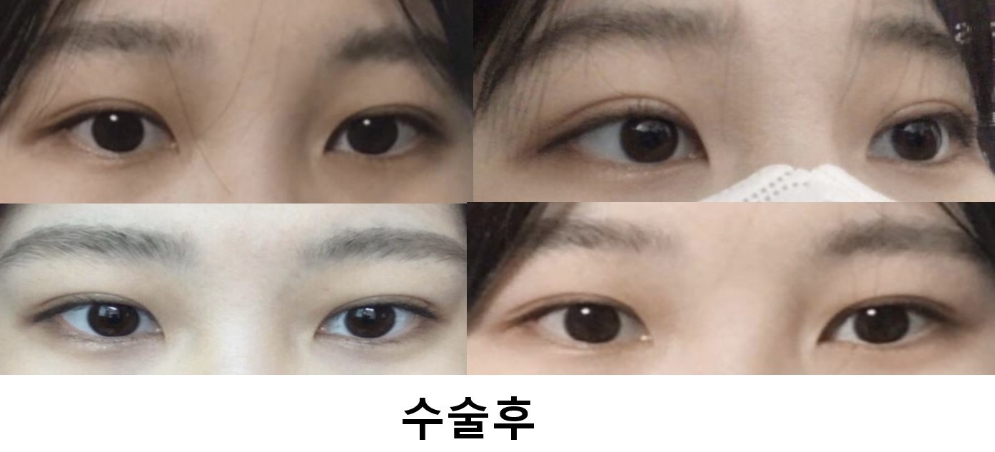 매몰 후기입니다아_!