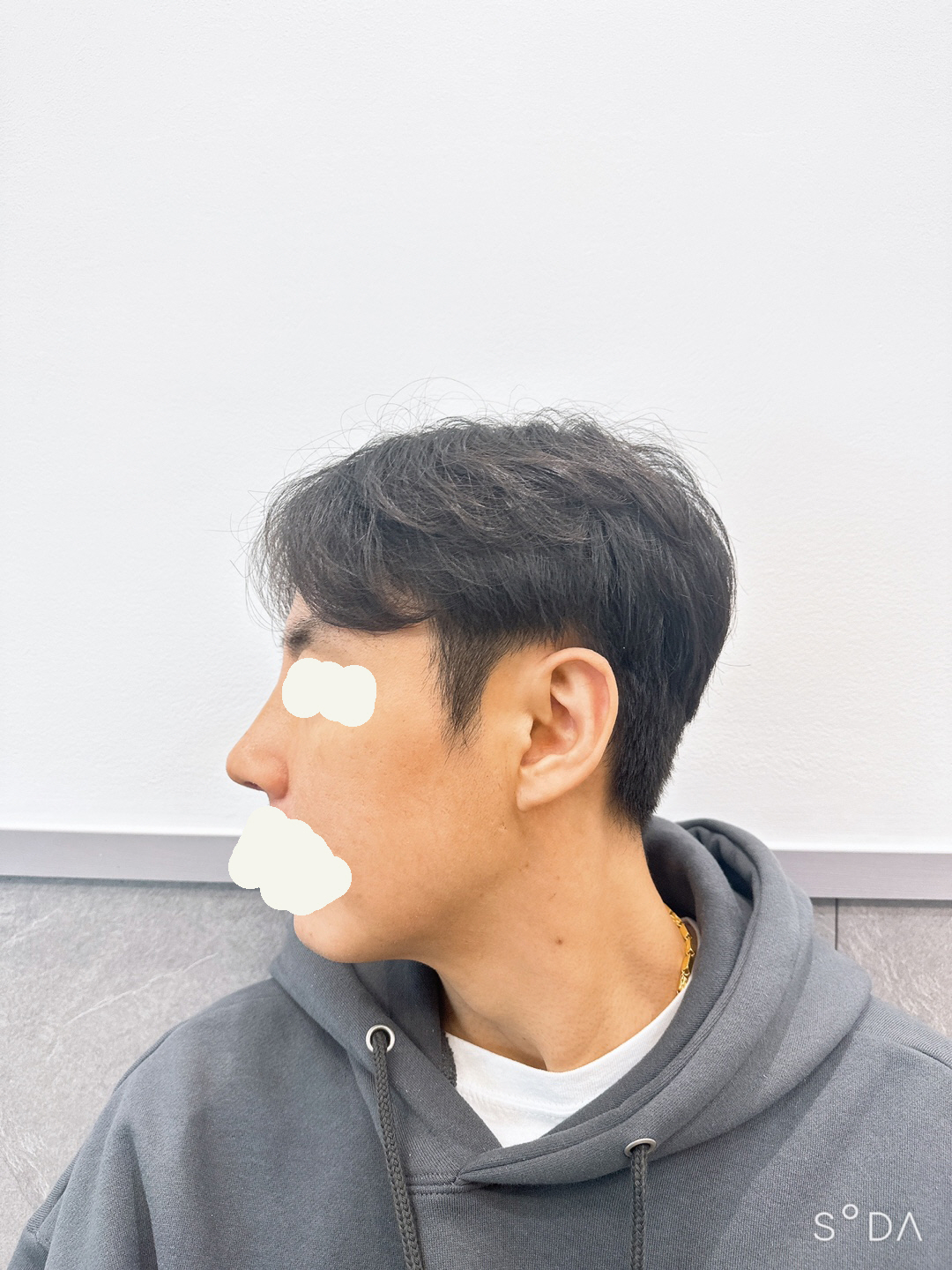 코 장인인 황정일 대표원장님에게 말투,자신감 보고 바로 그냥 믿고 수술 진행했습니다