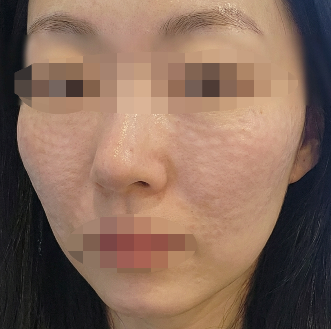 리쥬란이랑 미간보톡스 수면으로 받아서 동시에 받았는데 만족!