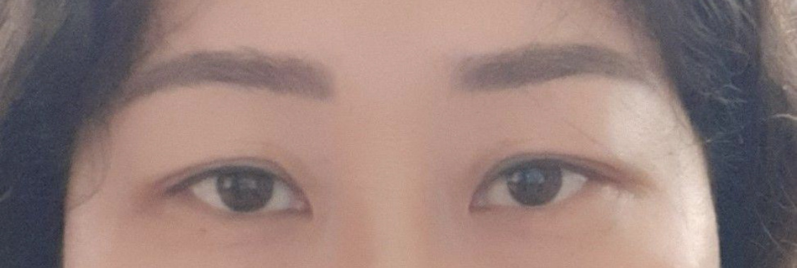 짝눈 교정했어요