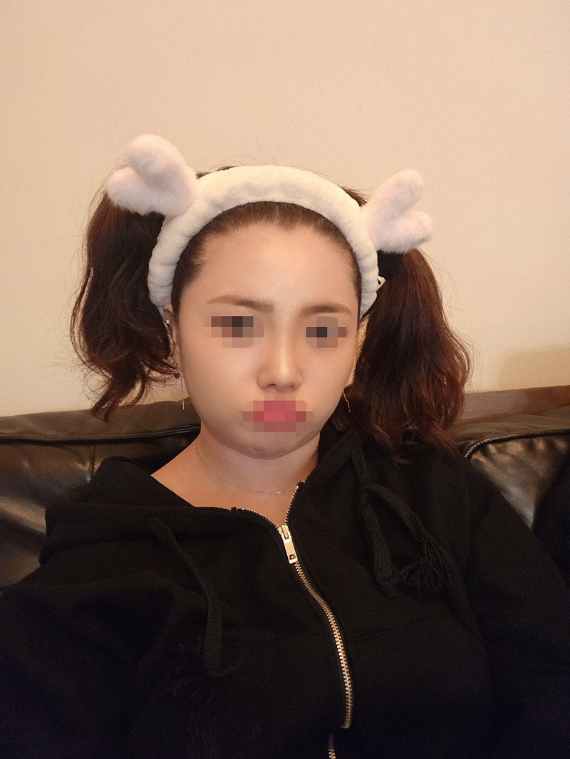 수술후 코도 자연스럽게 올라가고 얼굴대비 알맞게 올려주셔서 만족스럽습니다!!