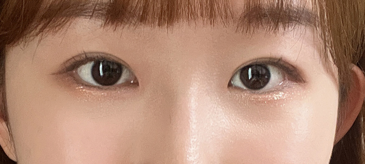 붓기 빠지니까 원래 얼굴이랑 조화가 되는 느낌이라 만족해요 ㅎㅎㅎㅎ