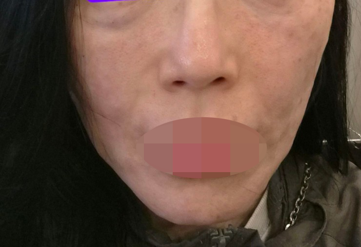 지인 소개로 방문한 곳, 부담 없이 받기 좋은 리쥬란 후기예요ㅎㅎ