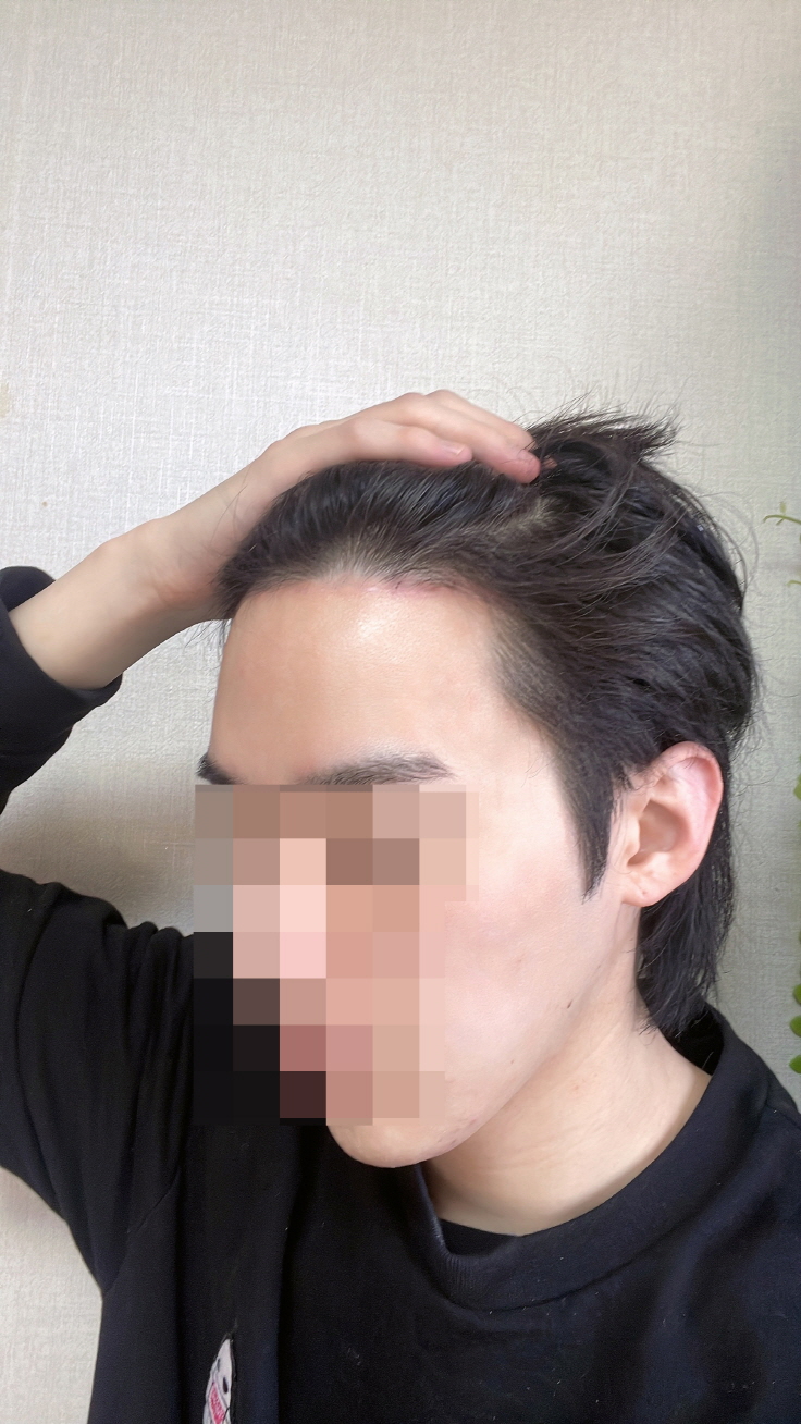 수술 후 관리도 너무 끝까지 잘 해주셔서 편하게 다녔습니다
